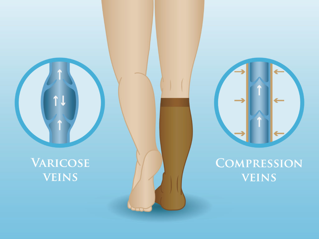 Varicose Vein